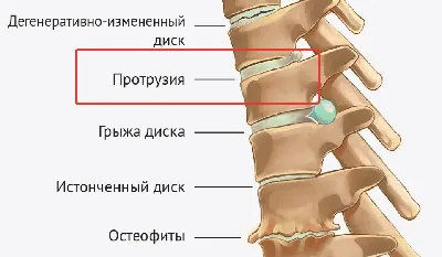 Лечение протрузии дисков шейного отдела позвоночника, симптомы и признаки