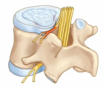 Протрузия l4-l5 поясничного отдела, шейного и грудного отдела позвоночника,  симптомы и лечение