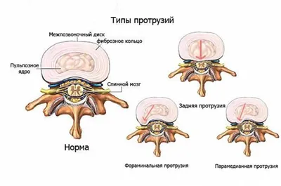 Протрузия шейного отдела позвоночника