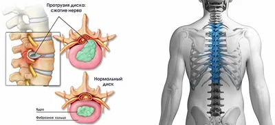 Лечение протрузии межпозвоночных дисков | Без Операции