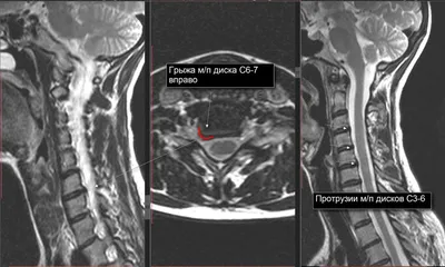 Дегенеративные изменения межпозвоночных дисков шейного отдела позвоночника  | Второе мнение
