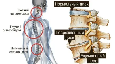 Протрузия дисков шейного отдела. Симптомы и лечение. | Митя Лободин