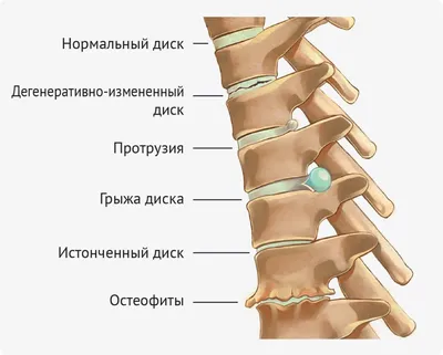 Лечение протрузии грудного отдела позвоночника в Екатеринбурге - Новая  больница