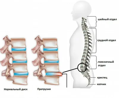 Протрузия межпозвонкового диска - лечение в Киеве - Vertebra