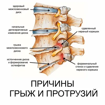 Протрузии и грыжи. Что нельзя? - YouTube