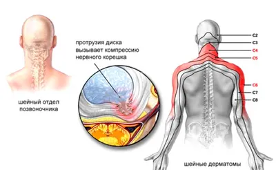Протрузия шейного отдела: причины, симптомы и лечение