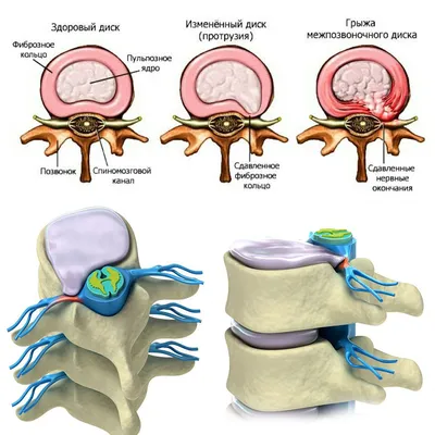 Протрузия дисков: лечение и реабилитация в Краснодаре | «Исток-Клиник»