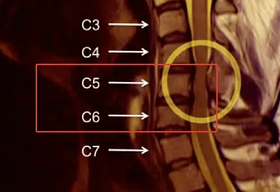 Stories of the treatment of intervertebral hernias and protrusions of our  patients without surgery, their MRI results and reviews - Vertebra