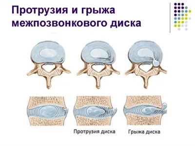 Остеохондроз