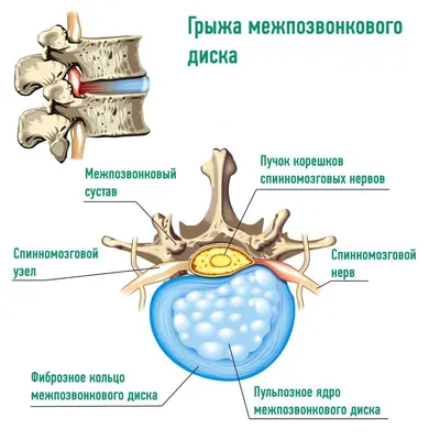 Протрузия шейного отдела – тяжелое заболевание позвоночника, которое  развивается при выпячивании межпозвоночного диска.. | ВКонтакте