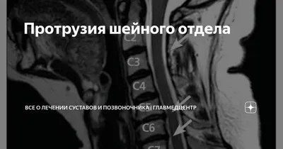 Протрузия дисков поясничного отдела позвоночника симптомы, лечение и  операция