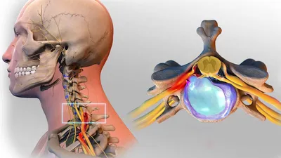 Как лечить протрузии шейного отдела