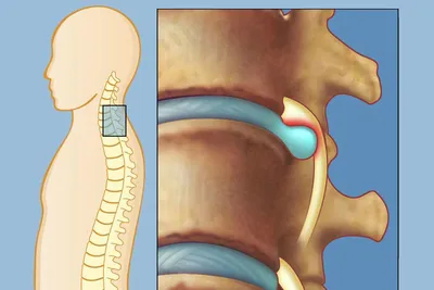 Протрузии и грыжи межпозвонковых дисков : в чем разница. Диагностика и  методы лечения