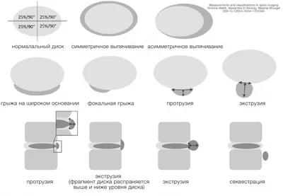 Лечение болей в спине Алматы. Грыжи, протрузии, остеохондроз