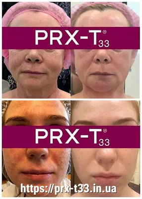 Prx пилинг фото до и после фото