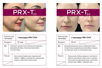 Пилинг для лица: цена от 4990 рублей в Москве | Стоимость пилинга PRX-T33 в  клинике BeautyWay Clinic