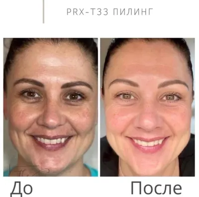 По совету косметолога попробовала пилинг PRX-t33 и была удивлена  результатом. Фото до и сразу после процедуры | K O S M E T O S | Дзен