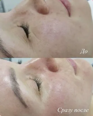 Пилинг PRX-T33: фото до и после, отзывы специалистов, как проходит  процедура | Пилинг лица, Жирная кожа, Косметолог