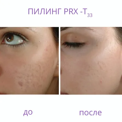 Пилинг PRX-T33, химический пилинг кожи без реабилитации, Киев
