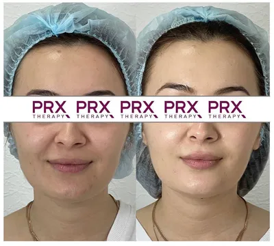 Пилинг PRX-T33: эффективность, достоинства и недостатки | Косметология и  эстетическая медицина | Дзен