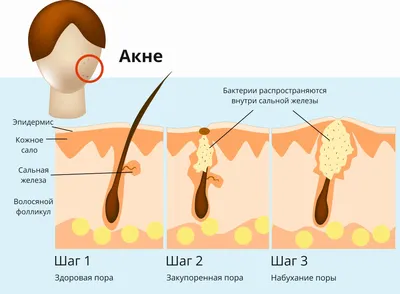 Стероидные угри: как вылечить угревую сыпь на спине и лице