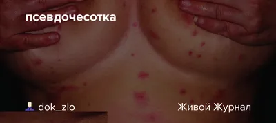 псевдочесотка: dok_zlo — LiveJournal