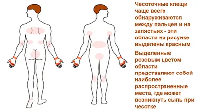 Чесотка у взрослых: симптомы, лечение, диагностика