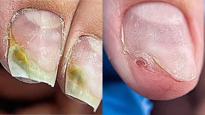 Плесень на ногтях: причины появления и лечение - Рамблер/новости