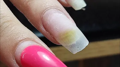 Псевдомония на ногтях - YouTube