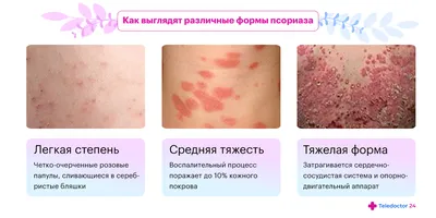 Псориаз: симптомы, лечение | Асмедия | Санкт-Петербург (СПб)