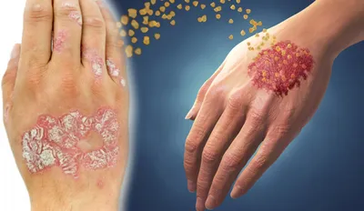 Dermatologs.lv - #Псориаз или чешуйчатый лишай – часто встречающееся  хроническое воспалительное #заболевание кожи, связанное с клетками верхнего  слоя кожи (#кератиноцитами), их ускоренным и неконтролируемым делением.  Различают два типа псориаза: 🔻 1 тип –