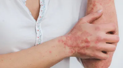 Псориаз (чешуйчатый лишай, psoriasis vulgaris)