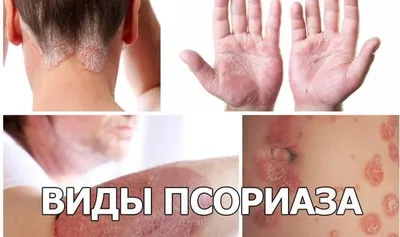 Лечение псориаза (чешуйчатого лишая) в Киеве — Derma.ua