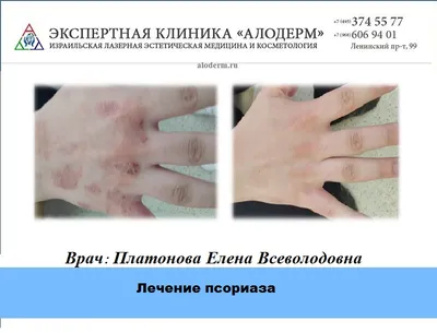 Лечение псориаза в Москве - фото до и после | Клиника АЛОДЕРМ Москва