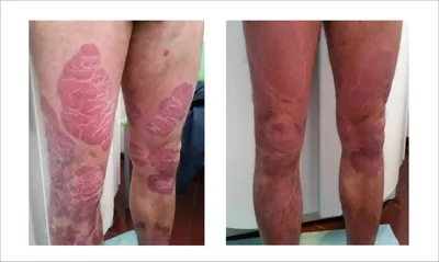 On Clinic Bishkek - ☝Делимся результатами лечение псориаза На фото  пациентка до и после лечения. 👆Псориаз — это хроническое неинфекционное  заболевание, которое поражает в основном кожу. 👆Он имеет разные виды и  форму,