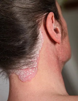 ᐉ Псориаз кожи головы - что это? Причины появления и методы лечения псориаза  на коже головы