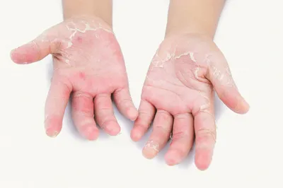 лечение кожных заболеваний. псориаз экзема дерматит диаза на человеческих  руках. концепции медицины и лечения Стоковое Изображение - изображение  насчитывающей сух, сравните: 231550959