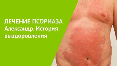 Клиника ОВИ - 🧬ЧТО ТАКОЕ ПСОРИАЗ? Псориаз — кожное заболевание,  проявляющееся пятнами красной, утолщенной и чешуйчатой кожи на различных  частях тела (псориатические бляшки). ⠀ 🧬ПОЧЕМУ ПОЯВЛЯЕТСЯ «БЛЯШКА»?. На  пораженных болезнью участках новые