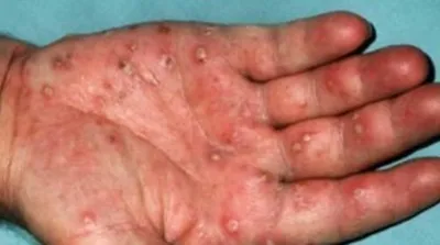 До и после лечения кожных заболеваний Псориаз На ладони Стоковое  Изображение - изображение насчитывающей дерматит, раздражение: 158546969