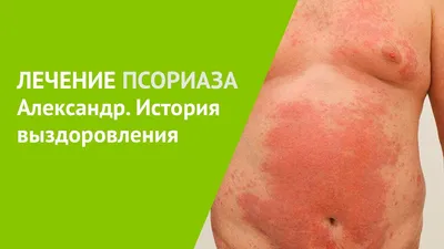 Лечение псориаза - Центр дерматологии в Москве