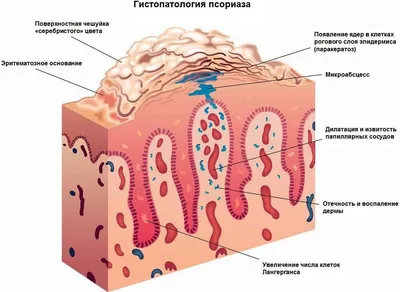 On Clinic Bishkek - ☝Делимся результатами лечение псориаза На фото  пациентка до и после лечения. 👆Псориаз — это хроническое неинфекционное  заболевание, которое поражает в основном кожу. 👆Он имеет разные виды и  форму,