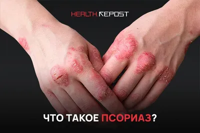 А какая терапия псориаза в XXI веке? | Psoriaz.Life | Дзен