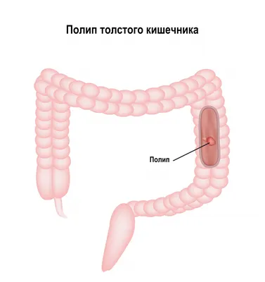 Псориаз ягодиц - Медправда