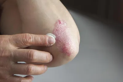 Экссудативный псориаз. Он локализуется обычно в складках кожи таких как  подмышки, пах, под грудью, вокруг гениталий и ягодиц. Проявляется… |  Instagram