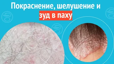 Псориаз: лечение клеточными препаратами - Coolaser Clinic