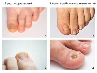 Лечение псориаза ногтей в Москве – лечение ногтей на руках и ногах в  клинике MedNail