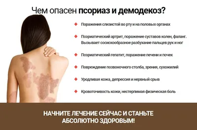 Psoriaz.life - ✍🏻ПСОРИАЗ НА НОГТЯХ: ОСОБЕННОСТИ И ЛЕЧЕНИЕ Псориаз на  ногтях рук и ног встречается примерно у 80-90% больных псориазом. Это может  быть самостоятельное состояние или дополнение к кожным проявлениям в виде