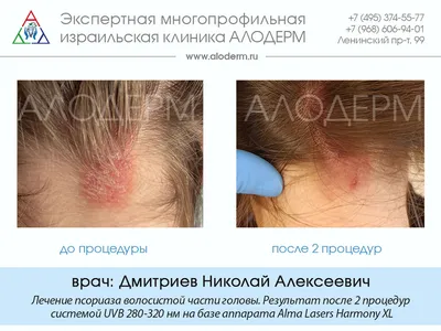 Псориаз волосистой части головы: симптомы, причины, лечение псориаза на  голове в Москве | Клиника АЛОДЕРМ | Клиника АЛОДЕРМ Москва