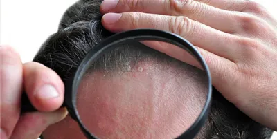 Противогрибковое средство Glenmark Антисеборейный шампунь Кето Плюс -  «Помогает в лечении псориаза волосистой части головы. Фото результата (не  для слабонервных).» | отзывы