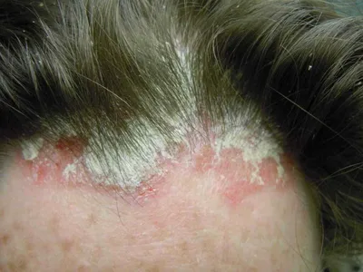 Псориаз на голове: лечение в СПб в клинике ТИБЕТСКИЙ ДОКТОР